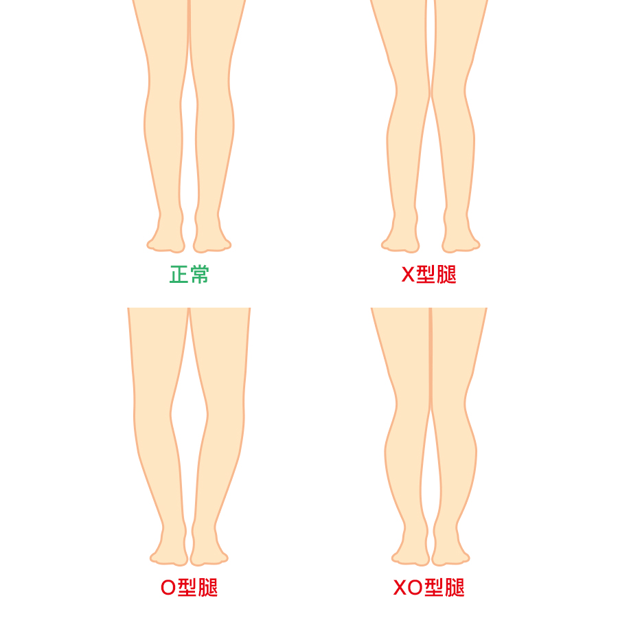 首先我們要先來了解一下腿型:一般分以上↑↑四種,正常腿型、X型腿、O型腿以及XO型腿...如果你是正常型腿,那摩登少女真的要恭喜你了,這種腿型也就是我們通常說的筷子腿,這種腿型的妹子穿什麼都好看...(羨慕)